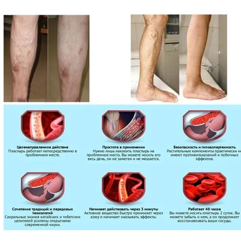 4Pcs Venų tepalas vaskulitas Gydymas, Išsiplėtusių Venų Kremas Flebitas Angiitis uždegimą kraujagyslių Supuvusios kojos