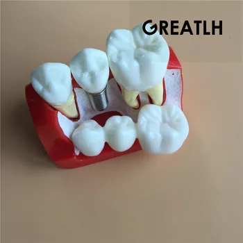 Dantų Implantai Analizė Karūna Tiltas dantų demonstravimas modelis Stomatologas Įrankiai Studijų Modelis