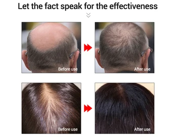 Greitai Plaukų Augimą Vyrams, Moterims Esmė Galingas Plaukų Priežiūros Eterinis Aliejus, Plaukų Slinkimas Produktų Apdorojimą Imbieras Gavyba