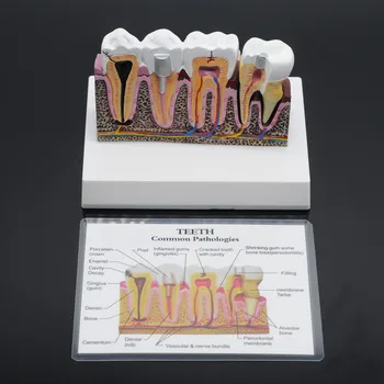 Ėduonies Demonstravimo Anatomijos Dantų Paplitusių Patologijų Modelis Dantų Nuimamas